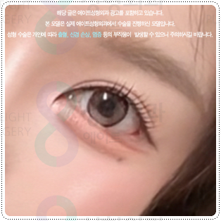강남 쌍커플 알아볼 때, 가격보다 먼저 확인해야 할 것 관련 이미지 4