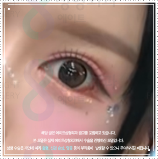 자연유착 쌍꺼풀 수술 후기 | 압구정 쌍수 밑트임 후 붓기 한달 변화 참고 후기 관련 이미지 5