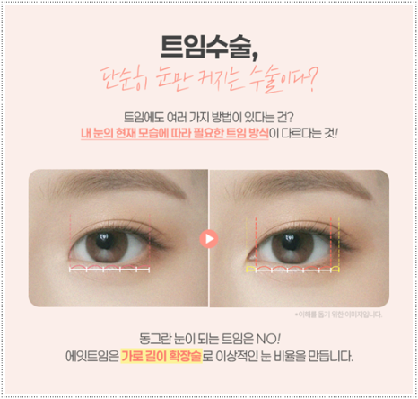 What Are the Prices and Combined Effects of Epicanthoplasty and Upper Epicanthoplasty with Double Eyelid Surgery? From Eye Shape Changes in Reviews of Front-and-Upper Epicanthoplasty to the Differences image 9
