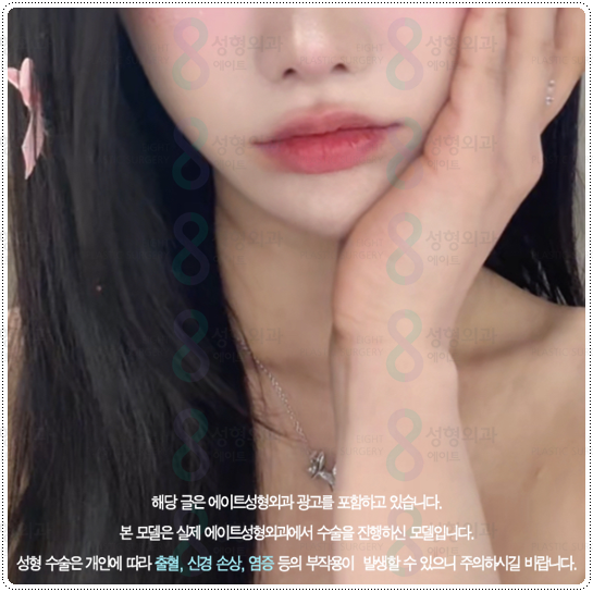 What Is the Difference Between 100 Shots and 300 Shots of Ulthera? Let’s Also Look at Ultherapy Prime Pricing and When Lifting Effects Appear image 2