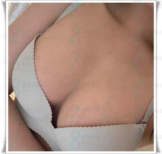 가슴확대 수술 가격, 보형물 종류 차이가 있나요? 관련 이미지 3