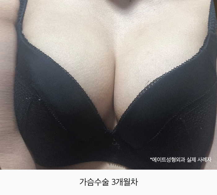 압구정가슴성형 원하는대로 자리할 수 있다면 관련 이미지 4