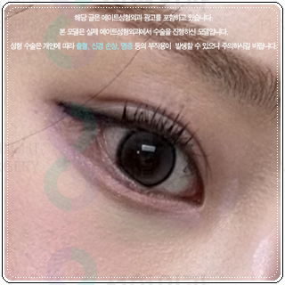 세미아웃라인 쌍수를 매몰로 하는법? 발품 비용 상담 후기 참고용 관련 이미지 2