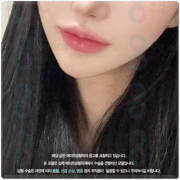 울쎄라 턱살에 효과 언제부터 있나요? (300샷 기준의 가격 평균은?) 관련 이미지 1