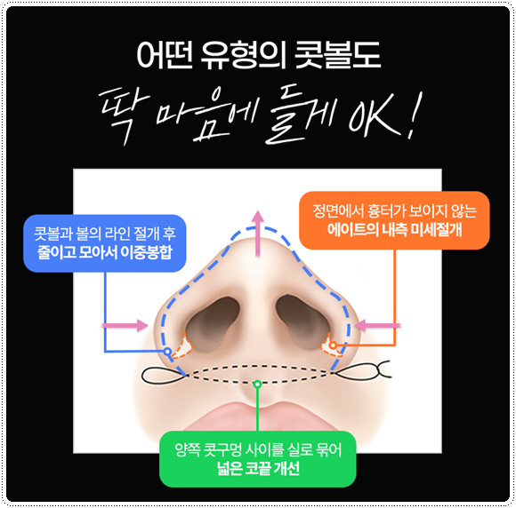 복코성형 콧볼축소 1개월 차! 코성형 붓기 빨리 빼는법과 코끝수술 후기 찾으셨나요? 관련 이미지 23