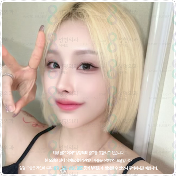 복코성형 콧볼축소 1개월 차! 코성형 붓기 빨리 빼는법과 코끝수술 후기 찾으셨나요? 관련 이미지 5
