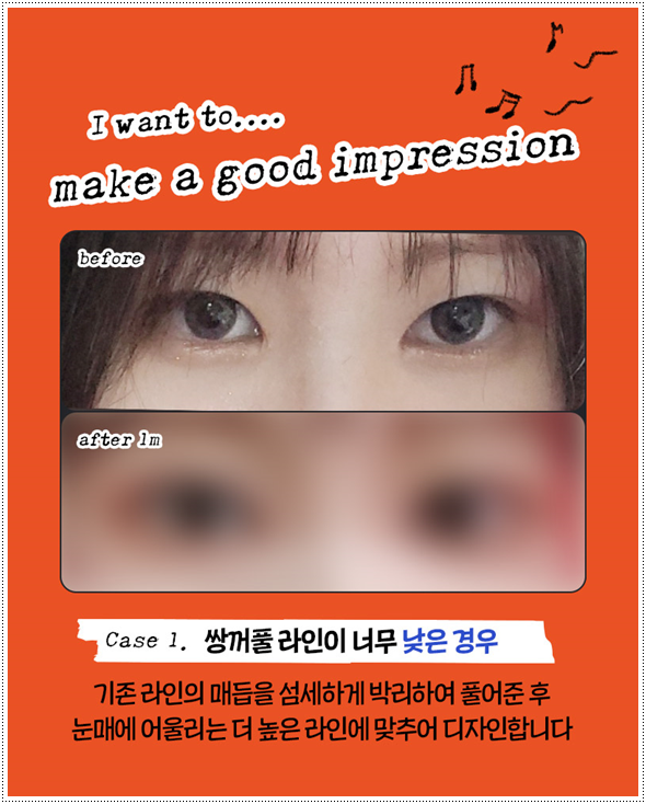 쌍커풀재수술 절개쌍수 말고 매몰은 못하나? 재수술 시 가격 얼마? 관련 이미지 10