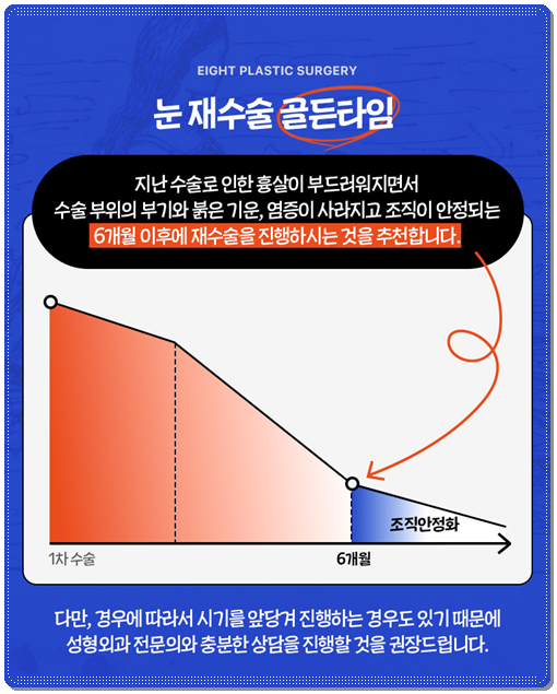 쌍꺼풀 라인을 다시 잡는 재수술, 매몰 방법과 비용은? 관련 이미지 14