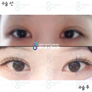 Best Place for Double Eyelid Revision Surgery ♥ Famous Place for Double Eyelid Revision Surgery ♥ Before and After Double Eyelid Revision Surgery image 1