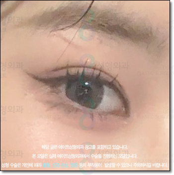 A Review of Upper Blepharoplasty Costs That Was Worth Every Penny! From How to Remove Mongolian Folds to Pricing and Recovery Care Tips image 2