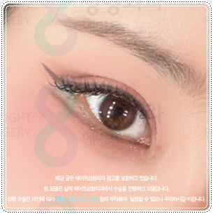 Suture or Incision? Which Double-Eyelid Design Looks Best? Understanding the Differences Between In-Out and In-Line Creases, Including the Semi-Out Line image 1