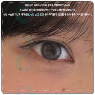 쌍꺼풀 라인을 다시 잡는 재수술, 매몰 방법과 비용은? 관련 이미지 2