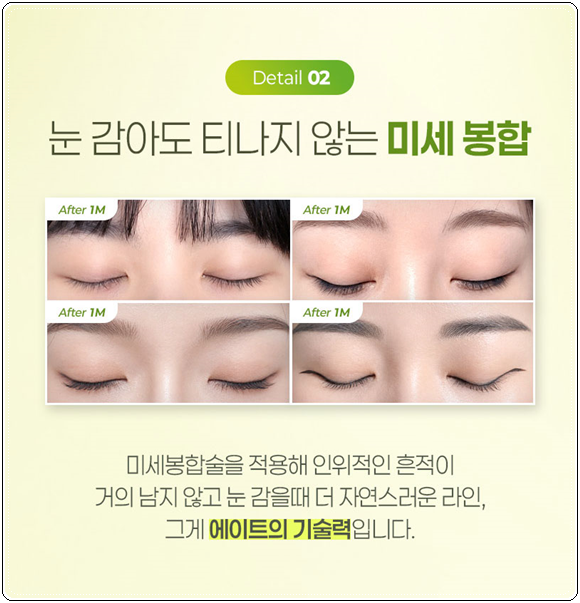쌍꺼풀 아웃라인? 인라인? 수술 고민, 자연유착과 절개의 비용 차이는? 관련 이미지 10
