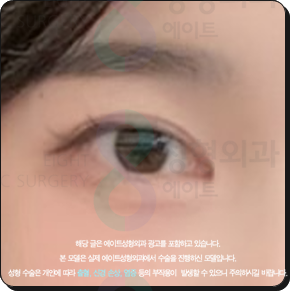 쌍꺼풀수술은 꼭 비절개가 좋을까? 부분절개와 절개의 비용 대비 효과는? 관련 이미지 2