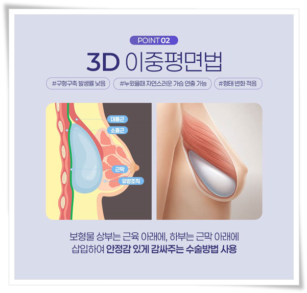 가슴성형 시 사용되는 보형물 종류와 가격 차이는 왜 생기나요? 관련 이미지 12