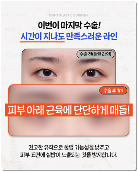 수술 가격이 다른 이유? 매몰과 절개 어떤 쌍꺼풀 재수술을 해야할까? 관련 이미지 8