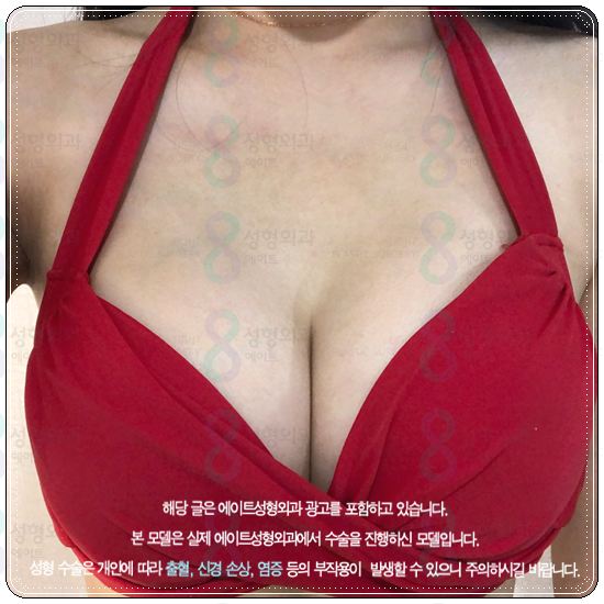 Pear-Shaped Breast Augmentation: Real-Review-Based Guide to Recovery Time, Feel, and Cost image 5
