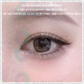 Natural Double Eyelid Surgery Using the Non-Incisional Method: A Budget and Consultation Guide for Middle School Students’ Eye Shapes Before and After Surgery image 2