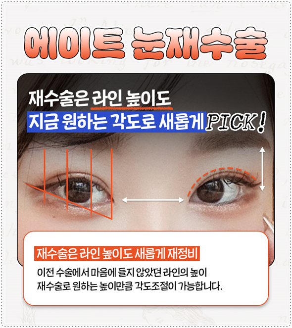 첫 쌍꺼풀 수술을 절개로 하고 눈 재수술은 매몰법(자연유착)으로 못하나? 비용 붓기는? 관련 이미지 9