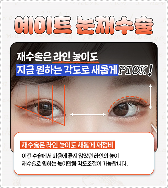 쌍커풀재수술 절개쌍수 말고 매몰은 못하나? 재수술 시 가격 얼마? 관련 이미지 9