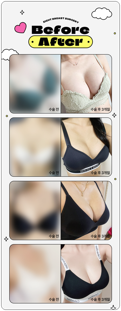 압구정성형외과유명한곳 가슴성형 시 알아봐야할 점은? 관련 이미지 13