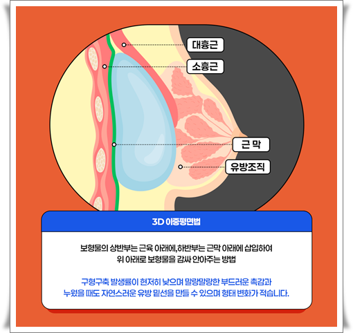 Breast Augmentation Surgery Cost Based on Mentor Implants image 10