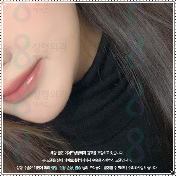 처지는 피부 고민? 리프팅 중 울쎄라 100샷은 300샷과 가격이나 효과가 많이 다른가요? (울쎄라피프라임) 관련 이미지 1