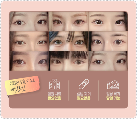 Preparing for the Cost and Swelling When Combining Medial and Lateral Canthoplasty with Double-Eyelid Surgery: A Comparison image 15