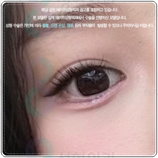 세미아웃라인 쌍수를 매몰로 하는법? 발품 비용 상담 후기 참고용 관련 이미지 4
