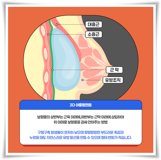 Best Places for Breast Augmentation: A Summary of Breast Implant Types, Pros, and Cons image 11