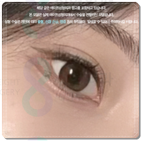 Ptosis Correction Cost: What Are the Criteria for Choosing Non-Incisional or Incisional Surgery? image 1