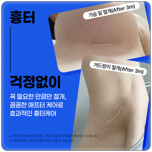 압구정성형외과유명한곳 가슴성형 시 알아봐야할 점은? 관련 이미지 14