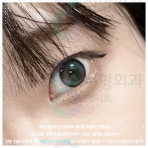 속쌍꺼풀 수술 티안나려면 인라인으로 해야할까? 관련 이미지 2