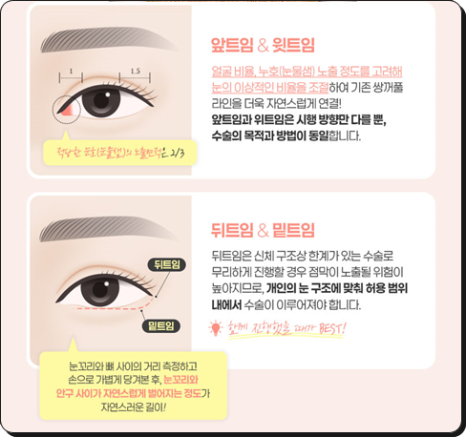 앞트임을 고민할 때, 눈매에 따라 달라지는 선택 관련 이미지 5