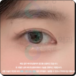 쌍꺼풀수술은 꼭 비절개가 좋을까? 부분절개와 절개의 비용 대비 효과는? 관련 이미지 3