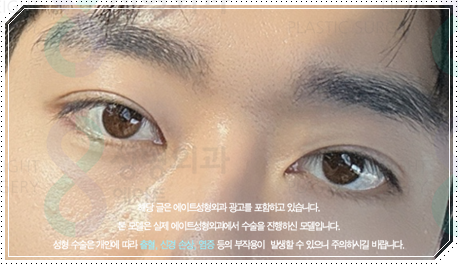 남자 쌍수 비용, 눈매교정 · 앞트임까지 하면 얼마나 달라질까? 관련 이미지 3
