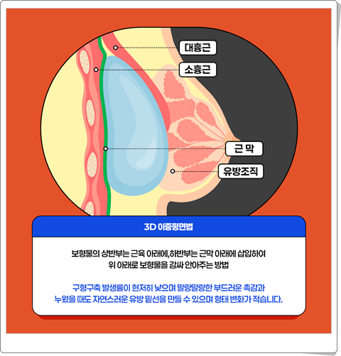 가슴확대수술비용 부작용 가능성을 낮추려면? 관련 이미지 16