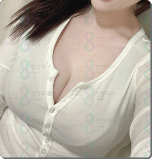 가슴성형 보형물 종류, 교체, 제거 시 모티바 보형물 재수술 알아보는 이유 관련 이미지 5