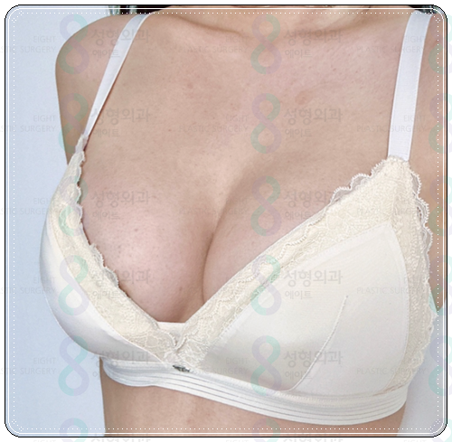 If You're Looking Into Breast Augmentation Cost Reviews, Be Sure to Read This image 5