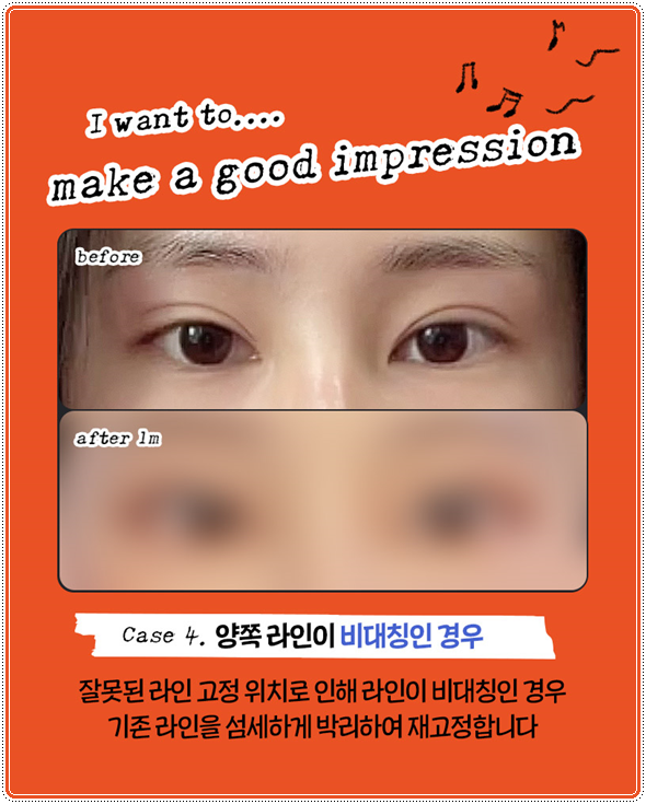 첫 쌍꺼풀 수술을 절개로 하고 눈 재수술은 매몰법(자연유착)으로 못하나? 비용 붓기는? 관련 이미지 14