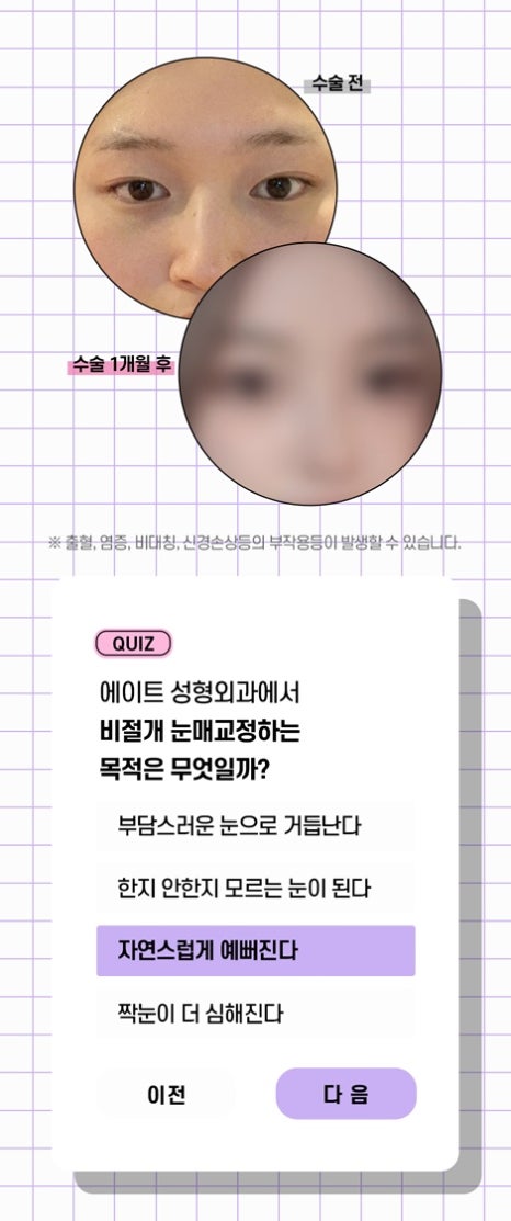 Eyelid Correction Surgery Review: Famous Eyelid Correction Clinic, Ptosis Surgery Before and After image 7