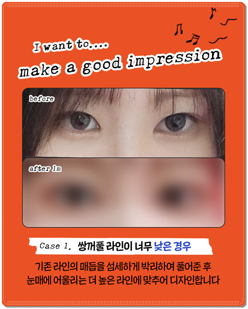 쌍꺼풀 라인을 다시 잡는 재수술, 매몰 방법과 비용은? 관련 이미지 7