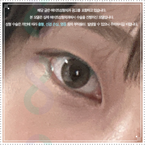인라인 쌍꺼풀 후기, 쌍수 전과 1개월 후 라인은 어떻게 달라질까 관련 이미지 5