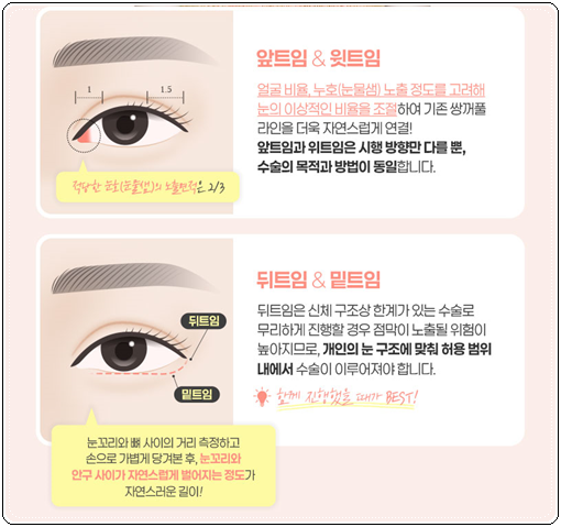 쌍커풀 하고 앞트임 수술을 해도될까? 쌍수 이후 라인 변화에 대해서 관련 이미지 8