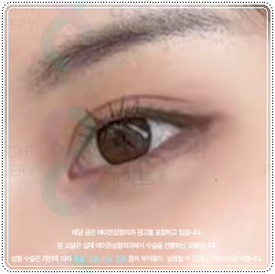 강남눈성형 | 쌍수 병원을 찾는다면? 비용, 후기, 선택전에 체크해보세요 관련 이미지 5