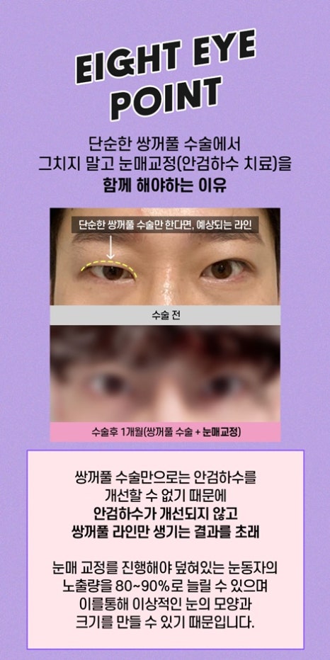Eyelid Correction Surgery Review: Famous Eyelid Correction Clinic, Ptosis Surgery Before and After image 9