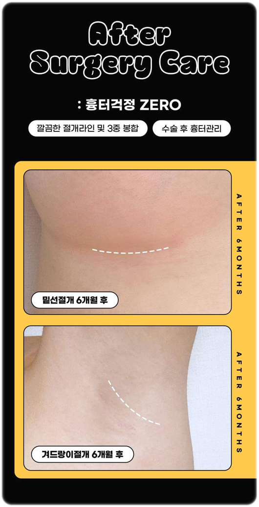 멘토엑스트라 장점, 가슴성형 부작용 (구형구축 리플링) 예방 후기 관련 이미지 8