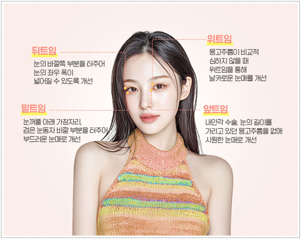 매몰쌍수와 앞트임 그리고 뒷트임, 밑트임까지 같이해도되나요? 관련 이미지 10