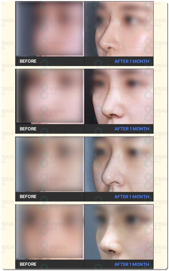 Bokko Rhinoplasty Review Summary! In Sinsa-dong, what are the costs of bokko surgery and the criteria for choosing a good clinic? image 26