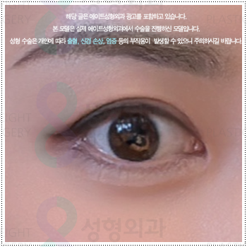눈 앞트임과 윗트임 준비, 내돈내산 후기를 찾아볼 때 수술 전후 확인할 것 (비용 등) 관련 이미지 5